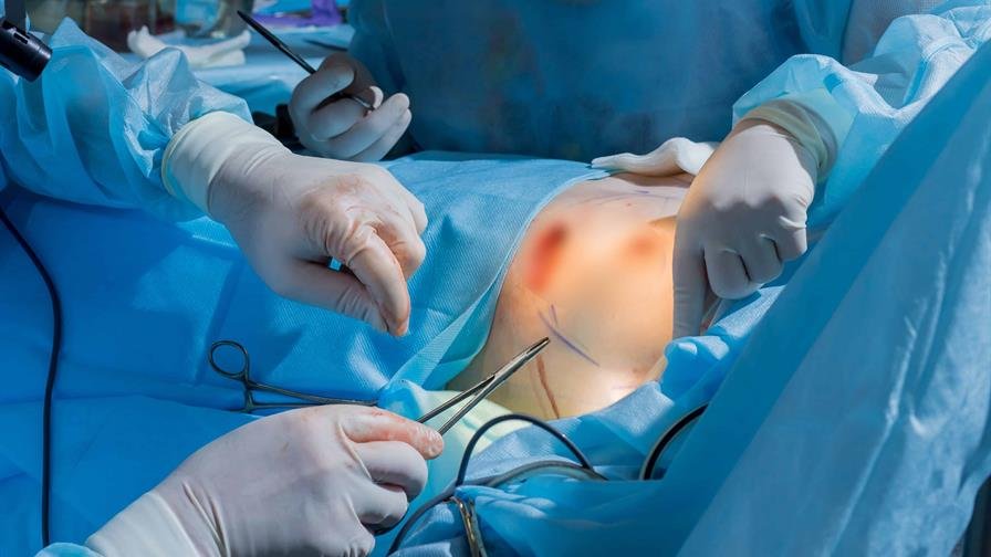 Realizan la primera cirugía de reducción mamaria en el país cubierta por una ARS