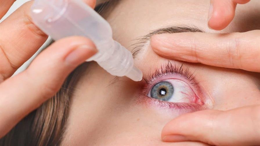 Conjuntivitis, una manifestación que puede estar asociada a la circulación de virus respiratorios